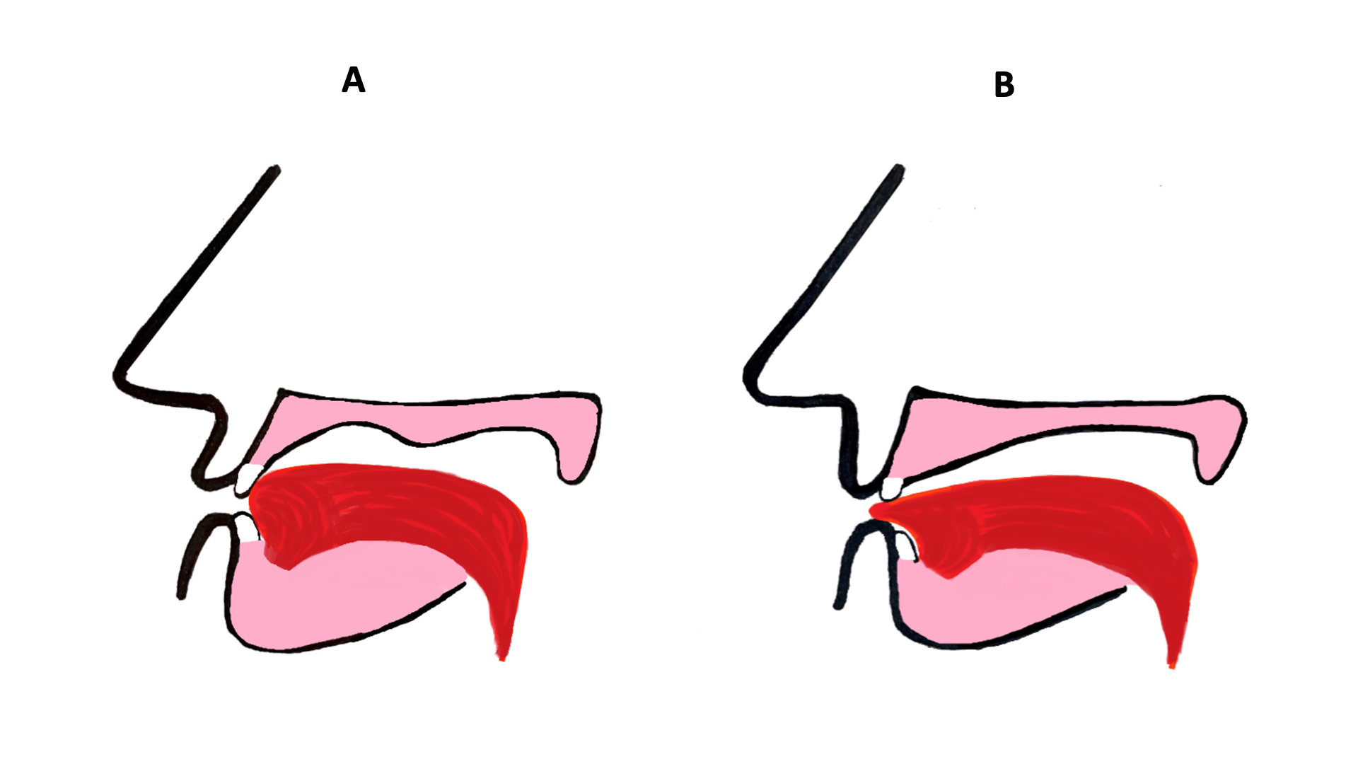 Mon Enfant A Un Cheveu Sur La Langue (sigmatisme Interdental), Comment ...